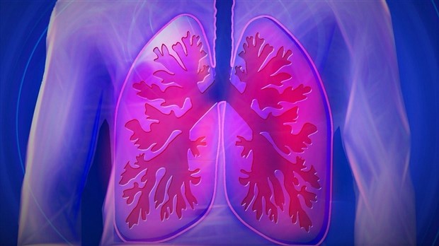Saviez-vous que le cancer pulmonaire est le plus meurtrier au Canada ?