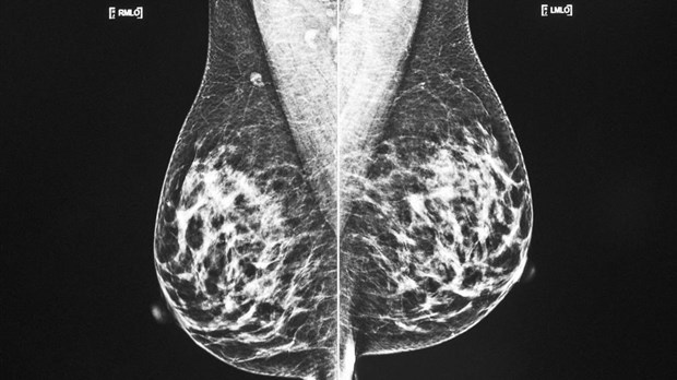 Cancer: la prévention et le dépistage fonctionnent, dit une étude
