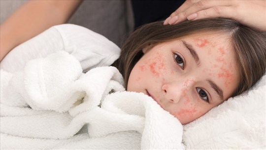 Prévention après des cas de rougeole dans la région de la Capitale-Nationale